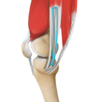 ACL Reconstruction Procedure – Hamstring Tendon 