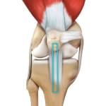 ACL Reconstruction Patellar Tendon