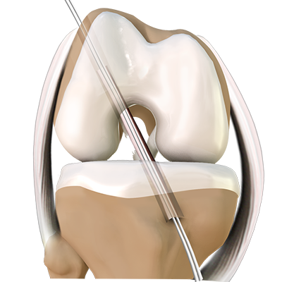 ACL Reconstruction