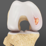 Chondral (Articular Cartilage Defects)