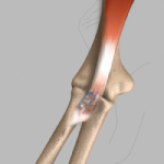 Biceps Tendon Repair