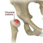 Chondral Lesions or Injuries