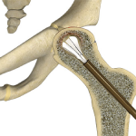 Core Decompression for Avascular Necrosis of the Hip 