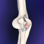 Elbow Ligament Reconstruction