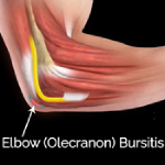 Elbow (Olecranon) Bursitis