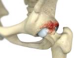 Femoroacetabular Impingement