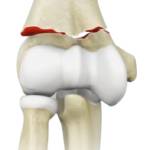 Elbow Fractures