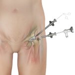 Hip Arthroscopy