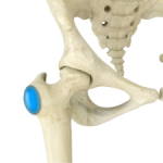 Hip Bursitis