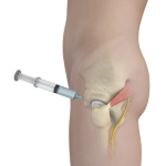 Hip Injections