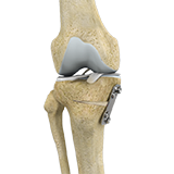 Knee Osteotomy