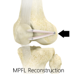 Medial Patellofemoral Ligament Reconstruction (Patella Stabilization)