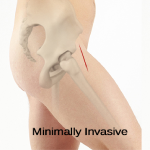 Minimally Invasive Total Hip Replacement