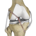 Multiligament Knee Reconstruction