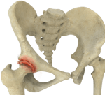 Osteoarthritis of the Hip