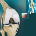 Fresh Osteochondral Allograft Transplantation