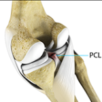 PCL Injuries