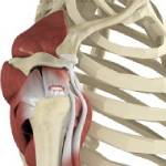 Rotator Cuff Tear