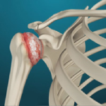 Arthritis of the Shoulder