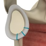 Shoulder Labrum Reconstruction