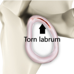 Shoulder Labrum Tear