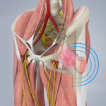 Snapping Hip Syndrome