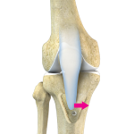 Tibial Tubercle Osteotomy (Patella Stabilization)