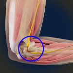 Ulnar Nerve Entrapment (Cubital Tunnel Syndrome)